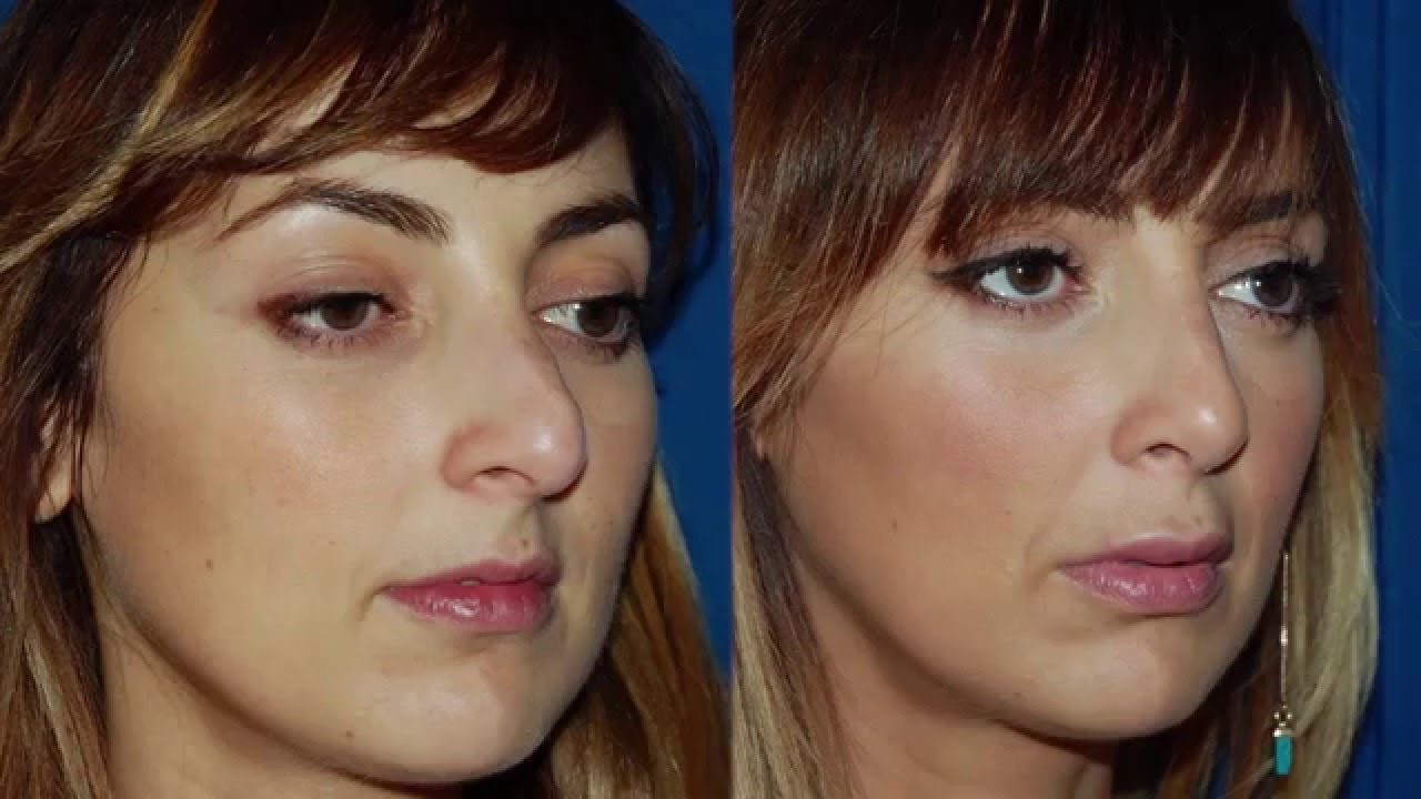 rhinoplastie à Lyon